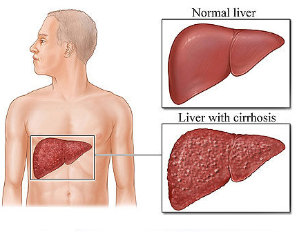 CHRONIC-LIVER-DISEASE