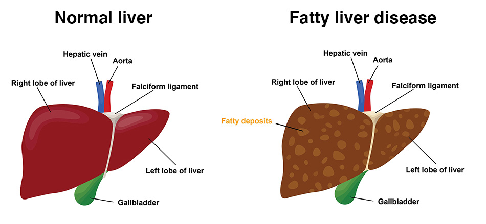 A side-by-side medical illustration comparing a healthy liver and a liver affected by fatty liver disease. The healthy liver appears smooth and dark red, while the fatty liver shows visible yellowish fat deposits and a rough texture.