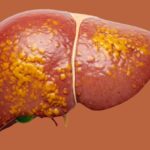 Non-Alcoholic Fatty Liver Disease diagnosis and treatment at Dr. Bhate’s gastroenterology clinic in Pune
