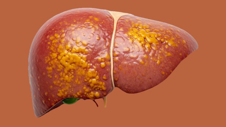 Non-Alcoholic Fatty Liver Disease diagnosis and treatment at Dr. Bhate’s gastroenterology clinic in Pune