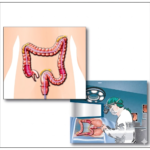 Colonoscopy myths vs facts explained by doctor