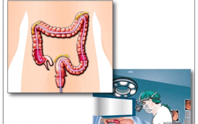 Colonoscopy myths vs facts explained by doctor