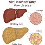 Fatty liver disease without alcohol caused by metabolic dysfunction and lifestyle-related risk factors