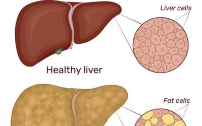 Fatty liver disease without alcohol caused by metabolic dysfunction and lifestyle-related risk factors