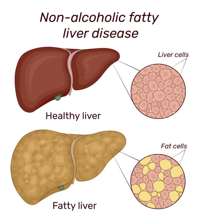 Fatty liver disease without alcohol caused by metabolic dysfunction and lifestyle-related risk factors
